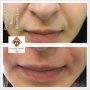 NOSE TO MOUTH LINES DERMAL FILLERS